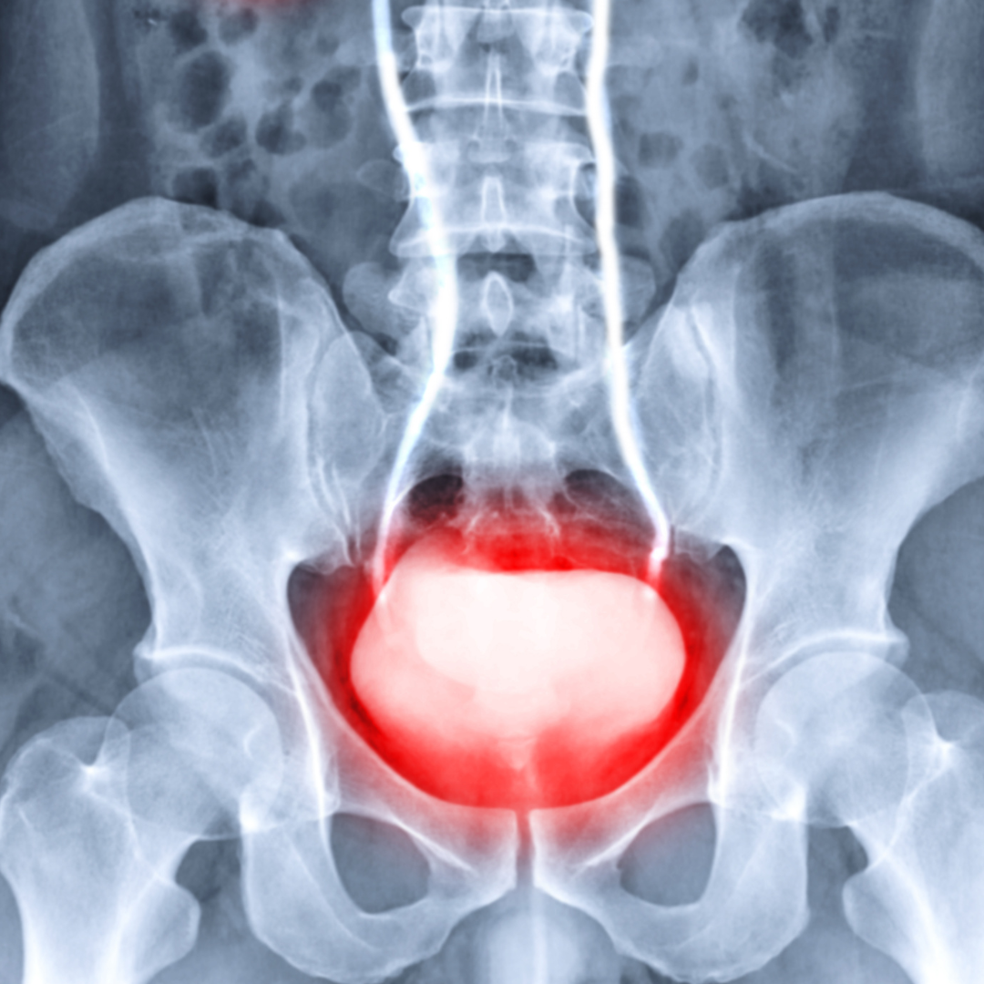 Bladder Retention: A Holistic Approach - 4 Cycles of Life Inc